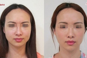 瘦脸针前后对比照片,瘦脸针前后惊人对比，效果立竿见影